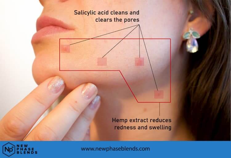 Cbd Hemp For Acne Treatment