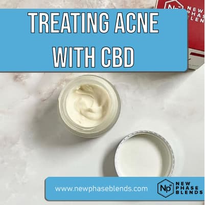 treating acne with CBD featured