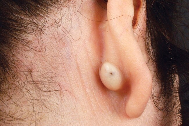 CBD for sebaceous cyst, cbd for cystic acne