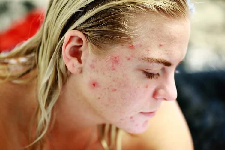 cystic acne example of face