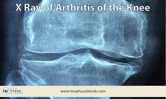 Joint Inflammation Xray From Arthritis
