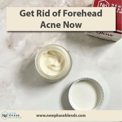 get rid of forehead acne thumbnail