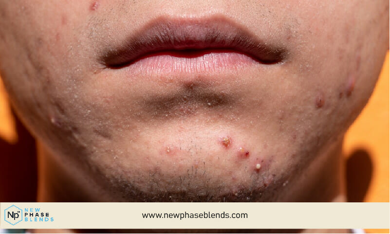 Picture Of Acne On A Teenager Chin