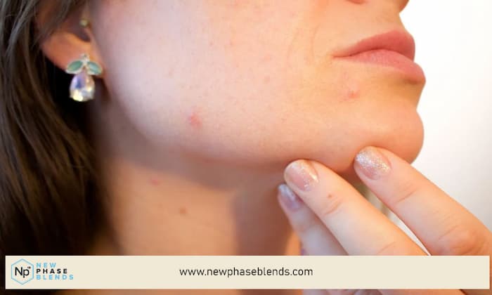 CBD for Acne Management: Does it Work? 7 pimples on chin