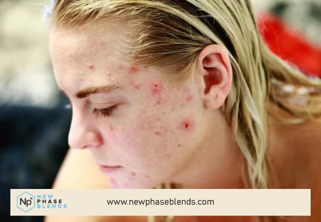 Acne On Teenager Face