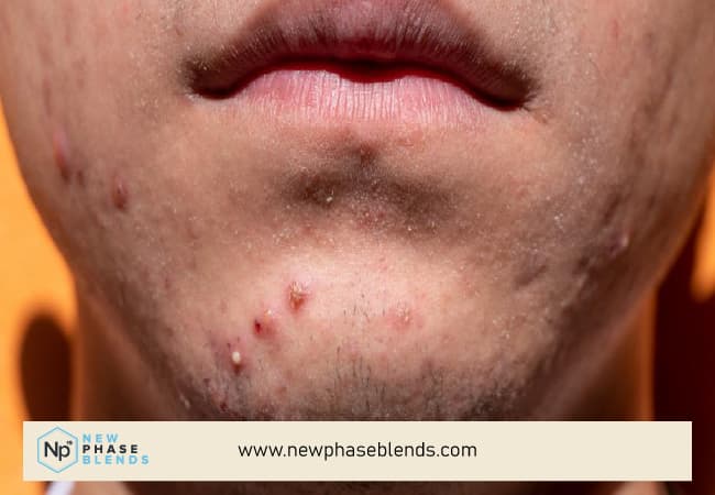 Isolated Pimples On A Chin