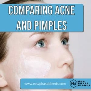 Pimples Vs Acne Featured