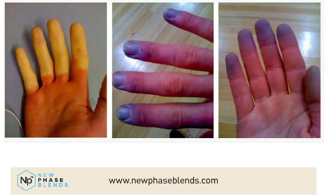 Raynauds Symptoms Appearance