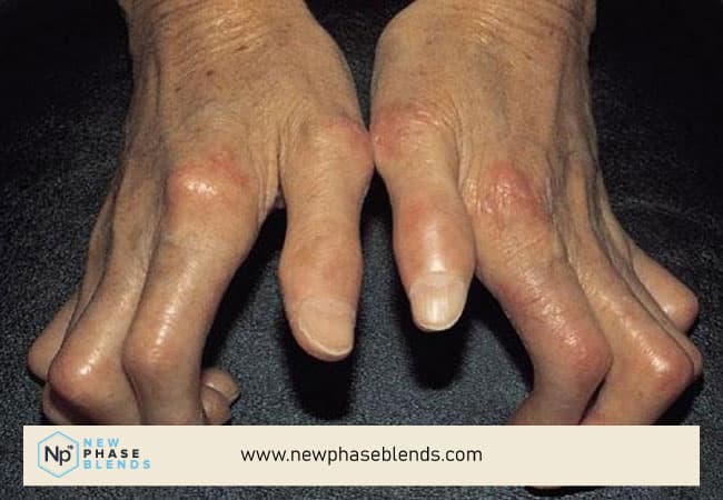 Scleroderma Hands