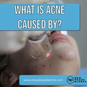 what is acne caused by featured